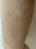 脂肪吸引（脚） / ボトックス（ふくらはぎ） THE CLINIC（ザ・クリニック） 福岡院 DAY 14 サムネイル用