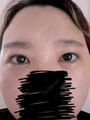 上まぶたたるみ取り / ダーマペン / 毛穴洗浄（ハイドラフェイシャルなど） Leap beauty clinic DAY 14 サムネイル用