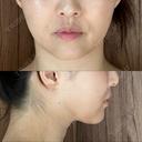 脂肪吸引（顔） / 脂肪吸引（脚） / 脂肪吸引（お尻） Mods Clinic（モッズクリニック） 福岡院 DAY 168 サムネイル用
