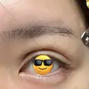 二重埋没 / ヒアルロン酸注入（涙袋） LOCHIC CLINIC GINZA【ロシッククリニック銀座】 DAY 1 サムネイル用