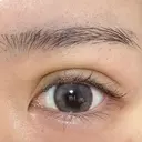 二重埋没 / ヒアルロン酸注入（涙袋） LOCHIC CLINIC GINZA【ロシッククリニック銀座】 DAY 4 サムネイル用