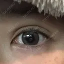 二重埋没 / ヒアルロン酸注入（涙袋） LOCHIC CLINIC GINZA【ロシッククリニック銀座】 DAY 12 サムネイル用