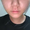 糸リフト / 脂肪吸引（顔） / ボトックス（エラ・小顔） ルラ美容クリニック 広島院 DAY 3 サムネイル用