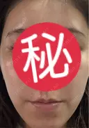 高濃度ビタミンC点滴 / ピーリング（ハリ・ツヤ） 表参道メディカルクリニック 表参道院 AFTER サムネイル用