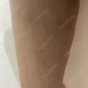 脂肪吸引（脚） / ボトックス（ふくらはぎ） THE CLINIC（ザ・クリニック） 福岡院 DAY 15 サムネイル用