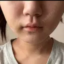 糸リフト / 脂肪吸引（顔） / ボトックス（エラ・小顔） ルラ美容クリニック 広島院 DAY 3 サムネイル用