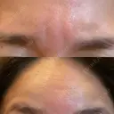 ボトックス（眉間） / ボトックス（額） / その他（鼻） ROOTS Clinic DAY 0 サムネイル用