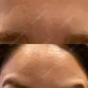 ボトックス（眉間） / ボトックス（額） / その他（鼻） ROOTS Clinic AFTER サムネイル用