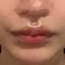 ヒアルロン酸注入（涙袋） / ヒアルロン酸注入（唇） フィラークリニック 渋谷院 AFTER サムネイル用