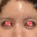 ヒアルロン酸注入（涙袋） / ヒアルロン酸注入（唇） フィラークリニック 渋谷院 DAY 3 サムネイル用