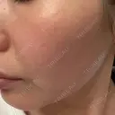 ダーマペン 共立美容外科 立川院 AFTER サムネイル用