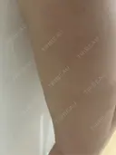 脂肪吸引（脚） / ボトックス（ふくらはぎ） THE CLINIC（ザ・クリニック） 福岡院 DAY 16 サムネイル用