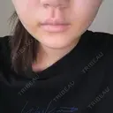 糸リフト / 脂肪吸引（顔） / ボトックス（エラ・小顔） ルラ美容クリニック 広島院 DAY 4 サムネイル用