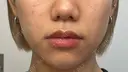 ボトックス（エラ・小顔） / ボトックス（肩） ちぐさ内科クリニック 覚王山 DAY 0 サムネイル用