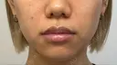ボトックス（エラ・小顔） / ボトックス（肩） ちぐさ内科クリニック 覚王山 AFTER サムネイル用