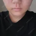 糸リフト / 脂肪吸引（顔） / ボトックス（エラ・小顔） ルラ美容クリニック 広島院 AFTER サムネイル用