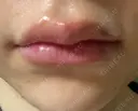 ヒアルロン酸注入（唇） REAL BEAUTY CLINIC 新宿東口院 AFTER サムネイル用