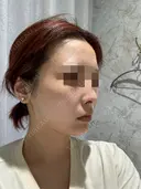 糸リフト / ボトックス（あご） / ヒアルロン酸注入（あご） Tokyo Tensei Clinic 銀座院 DAY 0 サムネイル用