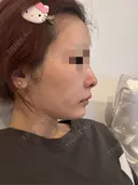 糸リフト / ボトックス（あご） / ヒアルロン酸注入（あご） Tokyo Tensei Clinic 銀座院 DAY 1 サムネイル用