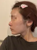 糸リフト / ボトックス（あご） / ヒアルロン酸注入（あご） Tokyo Tensei Clinic 銀座院 DAY 1 サムネイル用