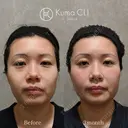クマ治療 Kuma CLI 【クマクリ】 AFTER サムネイル用