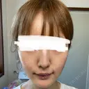 ボトックス（エラ・小顔） / ダーマペン ルラ美容クリニック 静岡院 DAY 11 サムネイル用