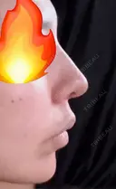 小鼻縮小（切開） / 鼻尖縮小 / 鼻柱下降・鼻唇角形成（猫手術） 東京シンデレラ美容外科 池袋院 DAY 17 サムネイル用