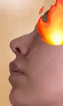 小鼻縮小（切開） / 鼻尖縮小 / 鼻柱下降・鼻唇角形成（猫手術） 東京シンデレラ美容外科 池袋院 DAY 17 サムネイル用