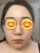 ピコレーザートーニング（美白・肝斑） / ピコフラクショナルレーザー（毛穴・ニキビ跡） おおかみ美容のクリニック 新宿院 DAY 1 サムネイル用