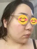 ピコレーザートーニング（美白・肝斑） / ピコフラクショナルレーザー（毛穴・ニキビ跡） おおかみ美容のクリニック 新宿院 DAY 1 サムネイル用