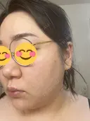 ピコレーザートーニング（美白・肝斑） / ピコフラクショナルレーザー（毛穴・ニキビ跡） おおかみ美容のクリニック 新宿院 DAY 1 サムネイル用