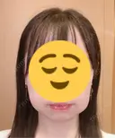 脂肪溶解注射（顔） TCB東京中央美容外科 青森院 DAY 0 サムネイル用