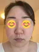 ピコレーザートーニング（美白・肝斑） / ピコフラクショナルレーザー（毛穴・ニキビ跡） おおかみ美容のクリニック 新宿院 DAY 4 サムネイル用