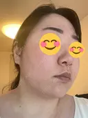 ピコレーザートーニング（美白・肝斑） / ピコフラクショナルレーザー（毛穴・ニキビ跡） おおかみ美容のクリニック 新宿院 DAY 4 サムネイル用