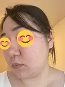 ピコレーザートーニング（美白・肝斑） / ピコフラクショナルレーザー（毛穴・ニキビ跡） おおかみ美容のクリニック 新宿院 DAY 4 サムネイル用