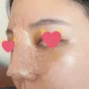 骨切幅寄せ 9BeautyClinic DAY 5 サムネイル用