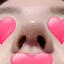 隆鼻術 / 鼻尖形成（切開） / 鼻中隔延長（切開） / 小鼻縮小（切開） / その他（鼻） / 骨切幅寄せ / 美容点滴・美容注射（美肌） FROM B整形外科 (旧バウム整形外科) DAY 17 サムネイル用