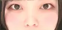 二重埋没 / 目頭切開 / 鼻尖形成（切開） / 軟骨移植 / 眉間プロテーゼ / 鼻尖縮小 グローバルビューティークリニック 大阪院 AFTER サムネイル用