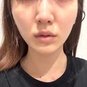 糸リフト / 脂肪吸引（顔） / ジョールファット除去 / ボトックス（エラ・小顔） R Beauty CLINIC 名古屋院 AFTER サムネイル用