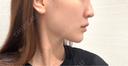 糸リフト / 脂肪吸引（顔） / ジョールファット除去 / ボトックス（エラ・小顔） R Beauty CLINIC 名古屋院 DAY 104 サムネイル用
