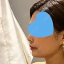 クマ治療 / ボトックス（あご） / ヒアルロン酸注入（あご） ネビュラクリニック 京都院 DAY 8 サムネイル用