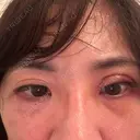 二重切開 / 傷跡修正 / 肌ヒアルロン酸注入（たるみ・シワ改善） / 美肌レーザー / シミ取りレーザー 石倉クリニック 水戸院 DAY 4 サムネイル用