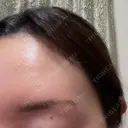 アートメイク（眉） 表参道メディカルクリニック 福岡天神院 AFTER サムネイル用