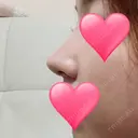 隆鼻術 / 鼻尖形成（切開） / 鼻中隔延長（切開） / 小鼻縮小（切開） / その他（鼻） / 骨切幅寄せ / 美容点滴・美容注射（美肌） FROM B整形外科 (旧バウム整形外科) DAY 17 サムネイル用