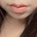 ヒアルロン酸注入（涙袋） / ヒアルロン酸注入（唇） 共立美容外科 梅田院 AFTER サムネイル用