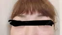 その他（目元） / クマ治療 / 上まぶたの脂肪取り / ヒアルロン酸注入（目の下） ROOTS Clinic AFTER サムネイル用