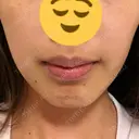 ボトックス（額） / その他（肌） Kaleido Clinic（カレイドクリニック） 横浜 AFTER サムネイル用