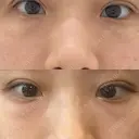 クマ治療 TCB東京中央美容外科 熊本院 AFTER サムネイル用