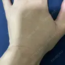 脂肪注入（肌） EMMO FACE CLINIC 大阪梅田院 DAY 8 サムネイル用