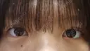 二重埋没 ルラ美容クリニック 渋谷本院 DAY 3 サムネイル用